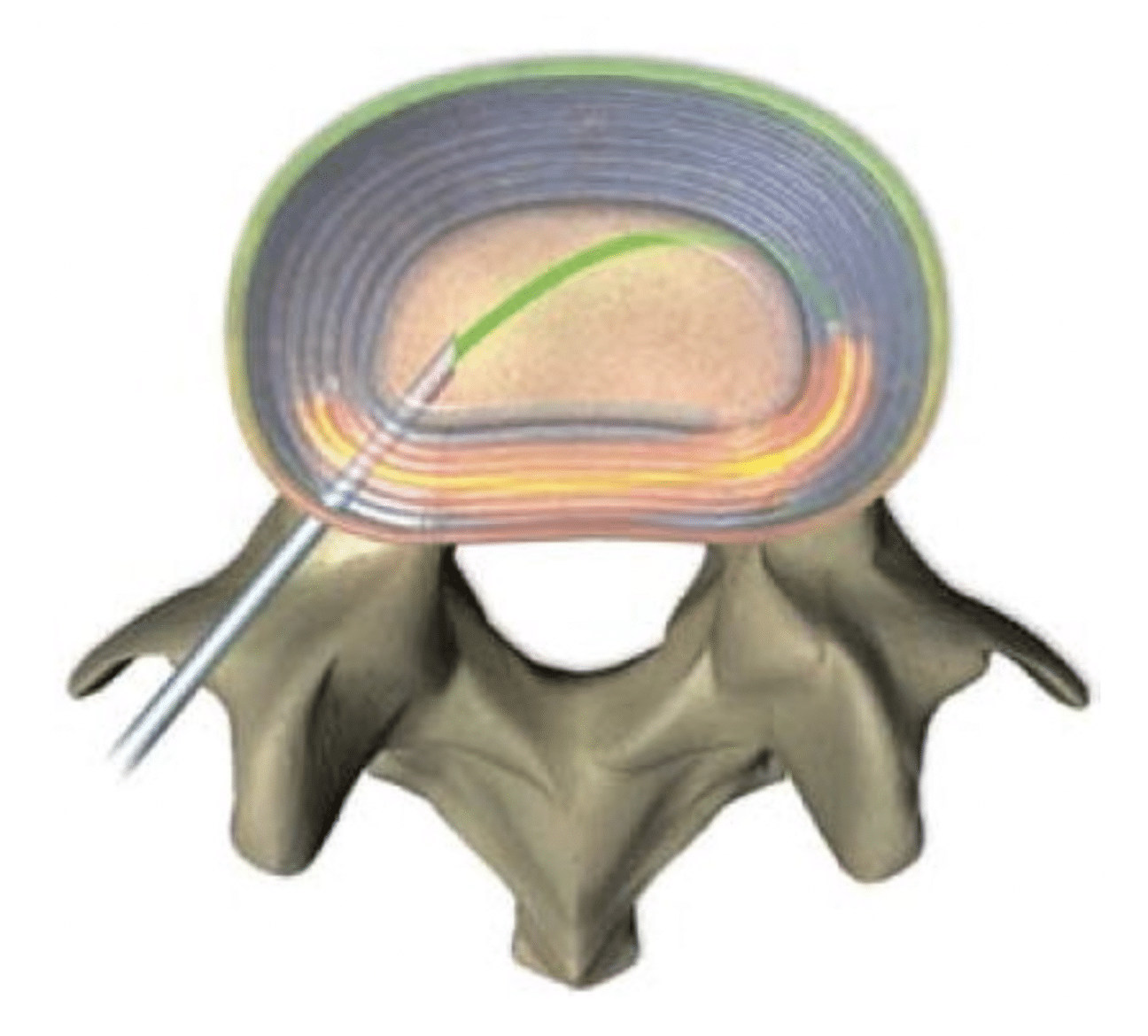 Intradiscal Electrothermal Therapy Everything You Need To Know Spine