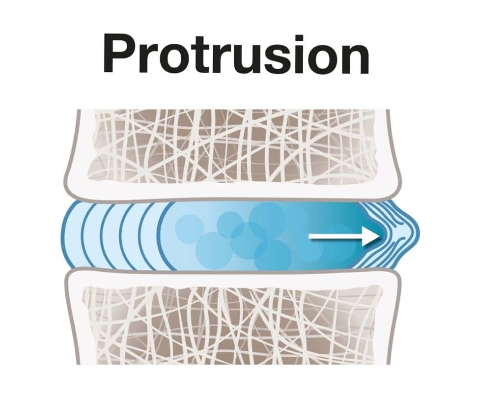 disc-protrusion-definition-spine-info