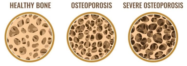 Osteoporosis: Symptoms, Causes, Diagnosis, Treatment, and Prevention ...