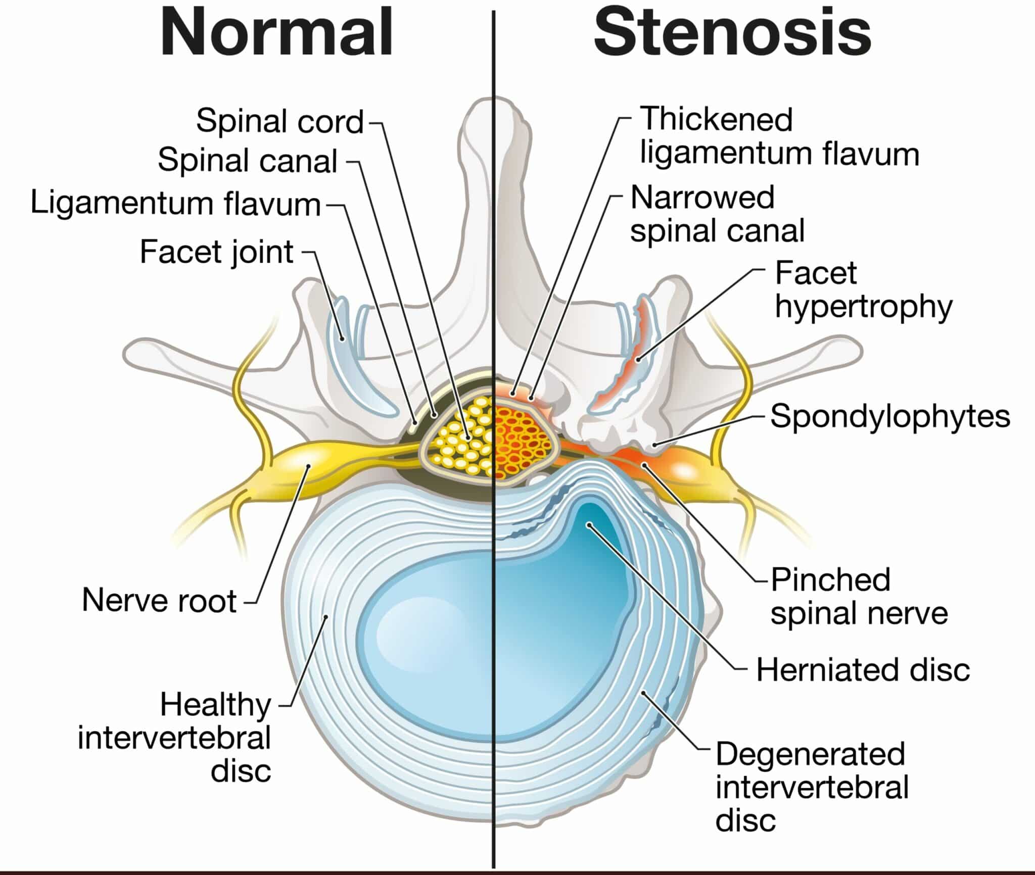 Central Canal Stenosis Definition Spine Info