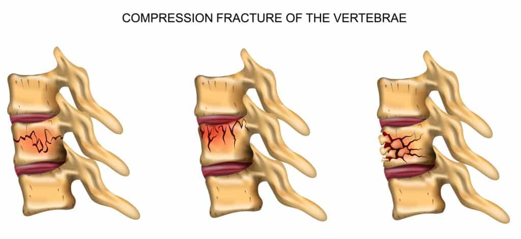 Spinal Fractures Types Causes Symptoms Diagnosis And Treatments