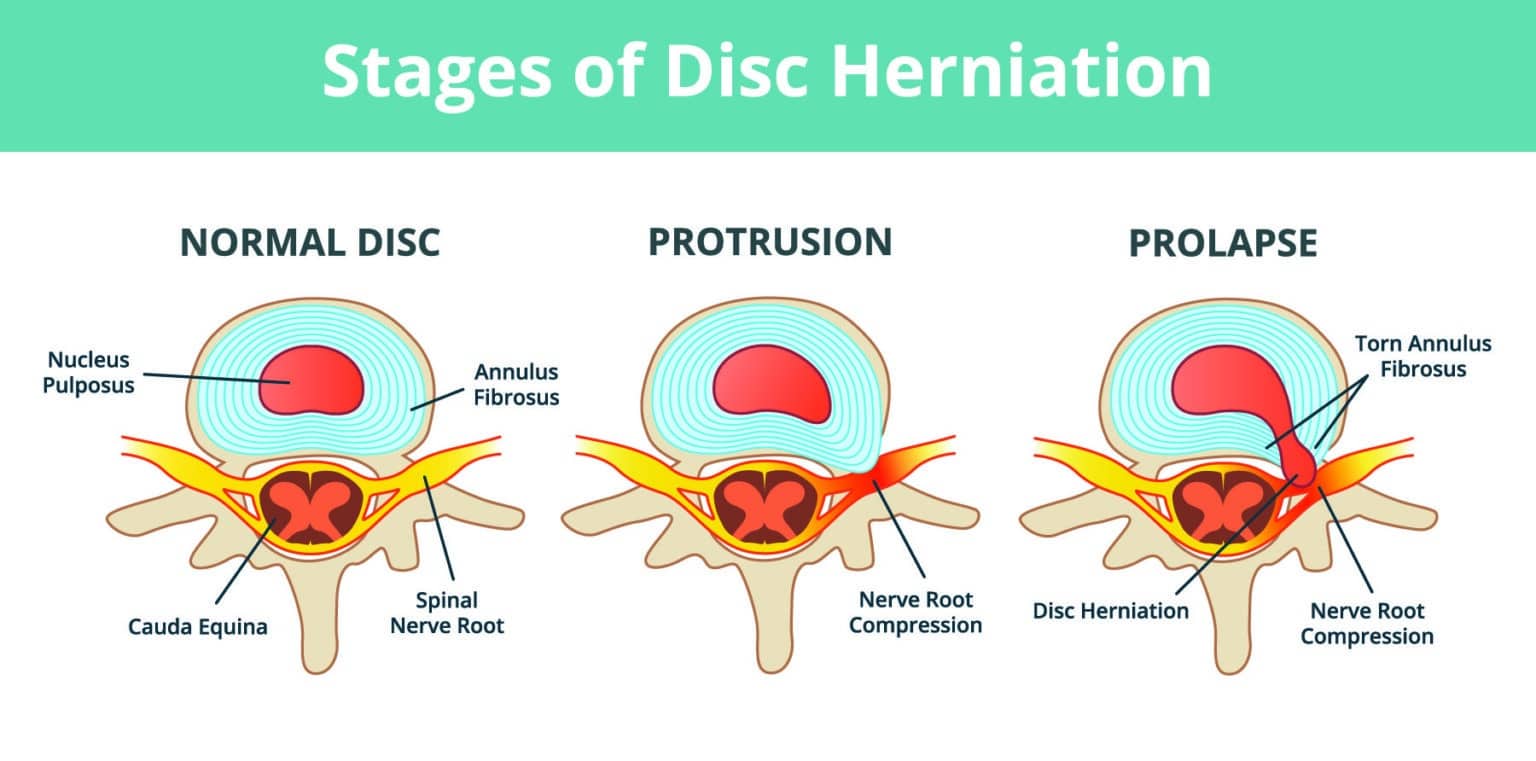 Disc Bulge: Definition - Spine Info