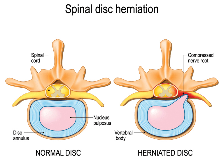 Herniated Disc – Definition, Causes, Symptoms, Diagnosis, and Treatment ...