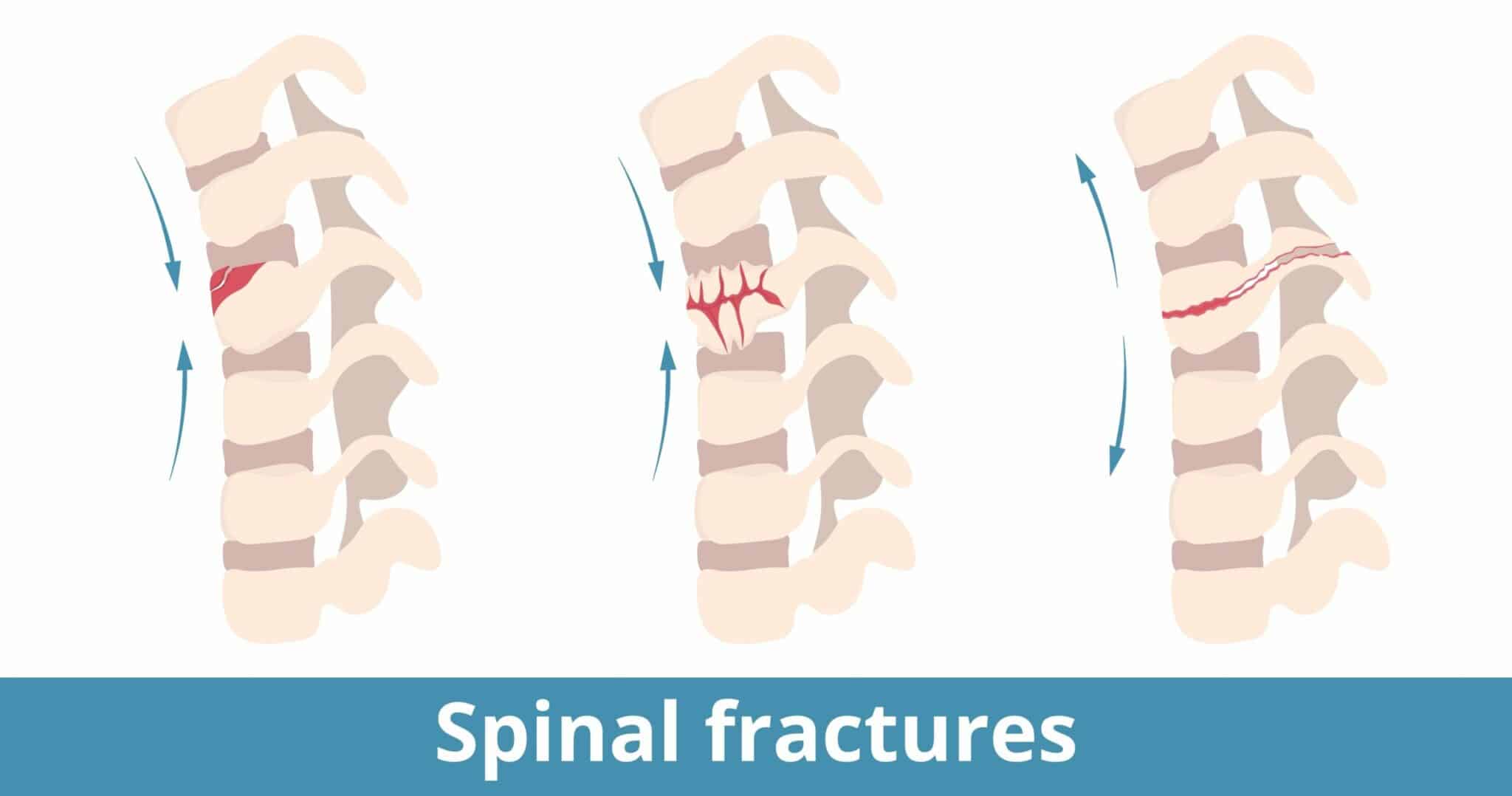 Types of Spinal Compression Fractures
