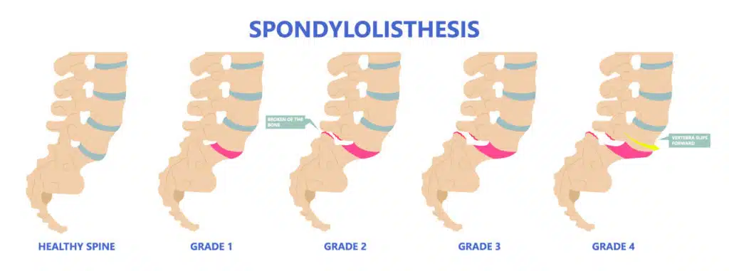 spondylolisthesis symptoms
