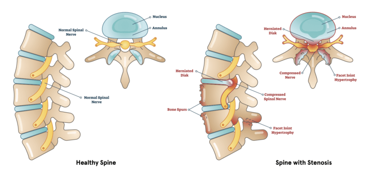 Spinal Stenosis: Definition, Causes, Symptoms, Diagnosis, And Treatment ...