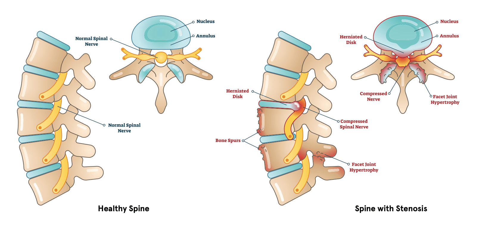 Spinal Stenosis: Definition, Causes, Symptoms, Diagnosis, and