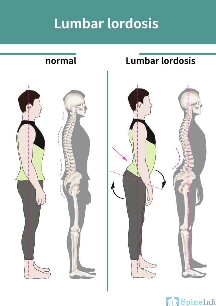 Lordosis: Definition, Causes, Symptoms, Diagnosis, And Treatment ...