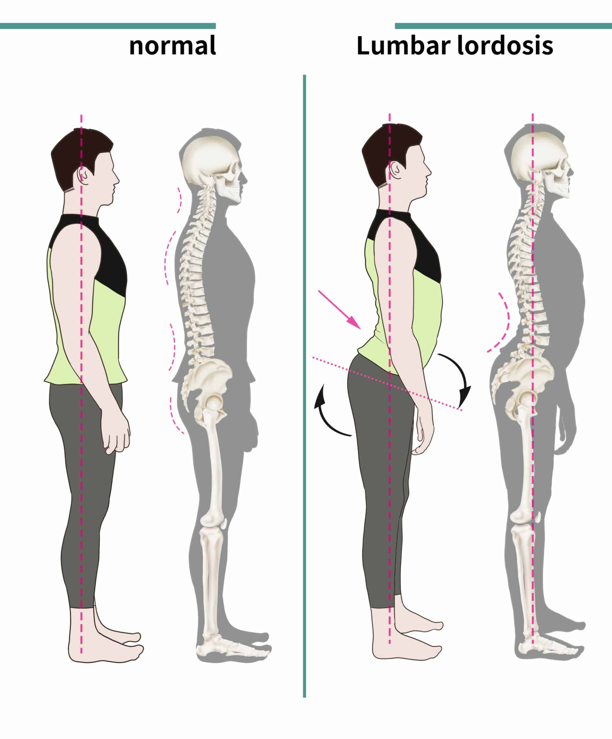 Lumbar Lordosis: Definition, Causes, Symptoms, Diagnosis, And Treatment ...