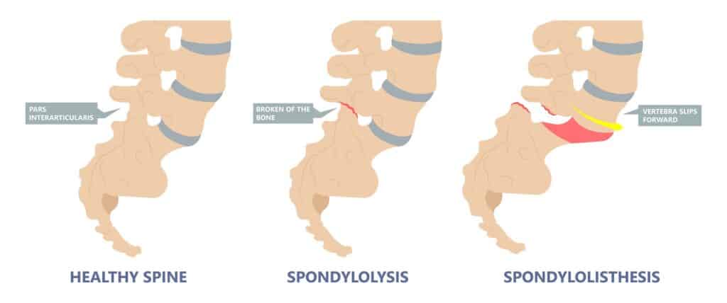 spondylolisthesis early symptoms