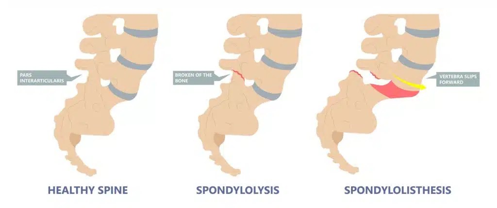 spondylolisthesis symptoms and treatment