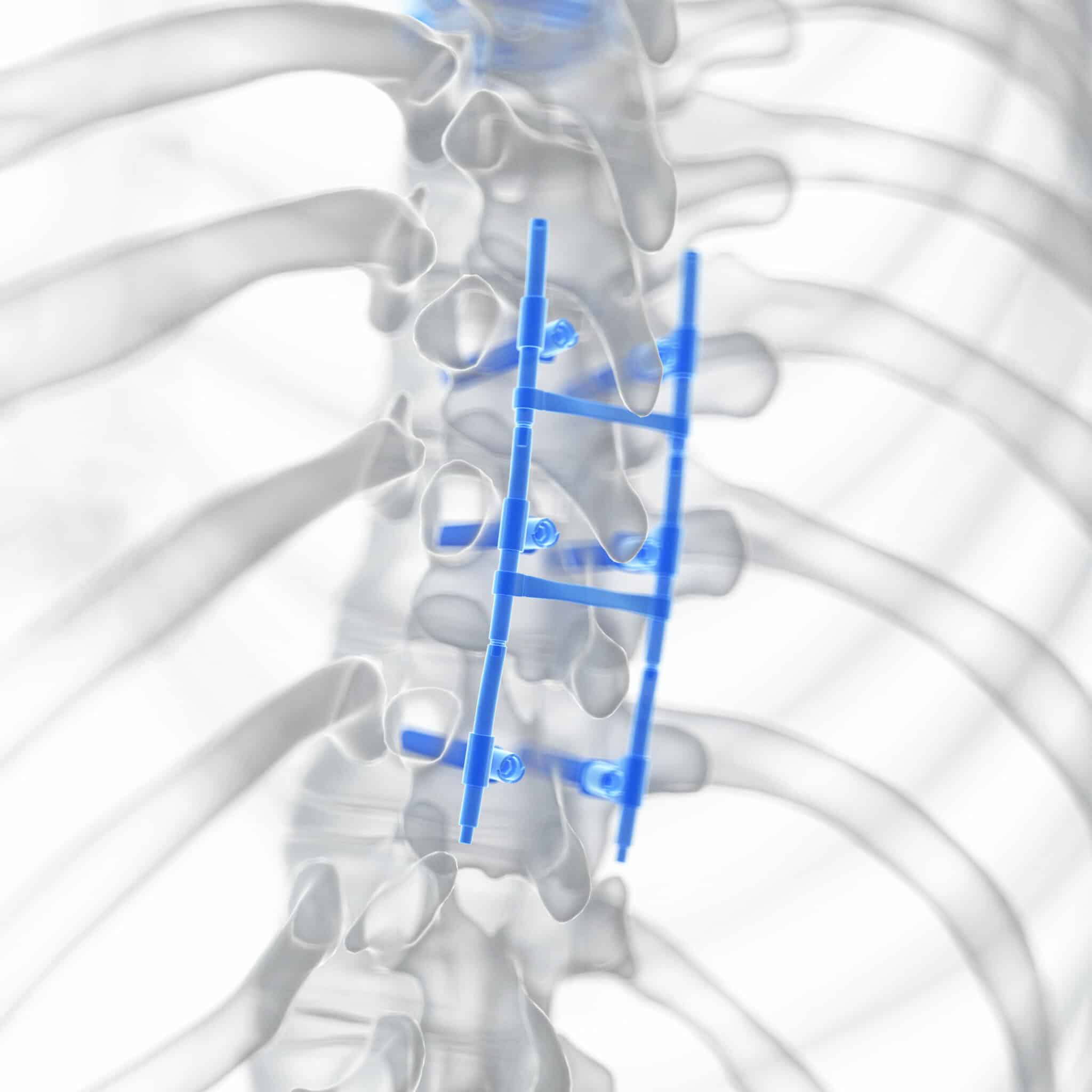 Spinal Fusion Surgery - Spine Info