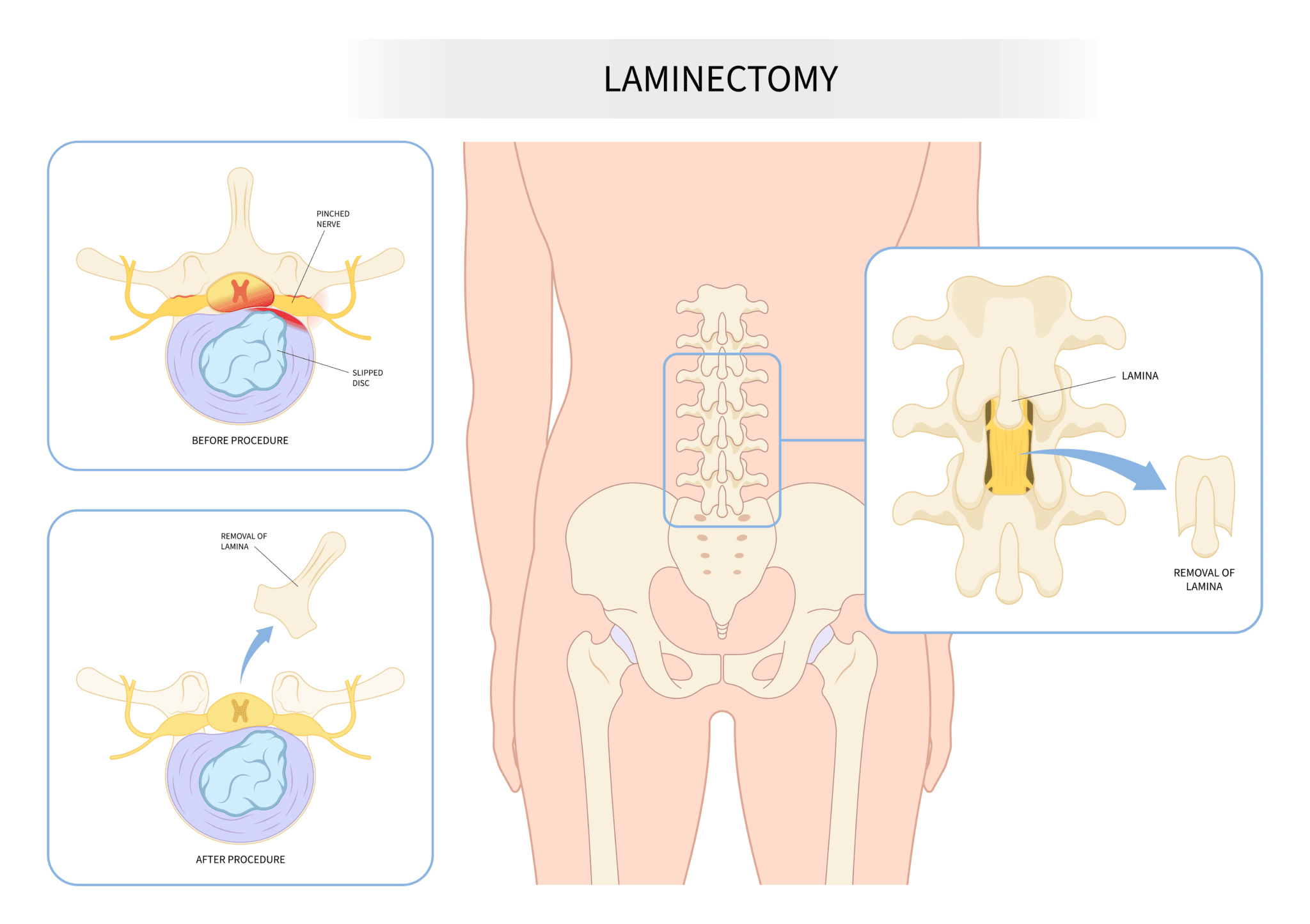 Laminectomy Spine Info 