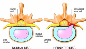 Normal Spinal Cord vs Compressed Nerve Root