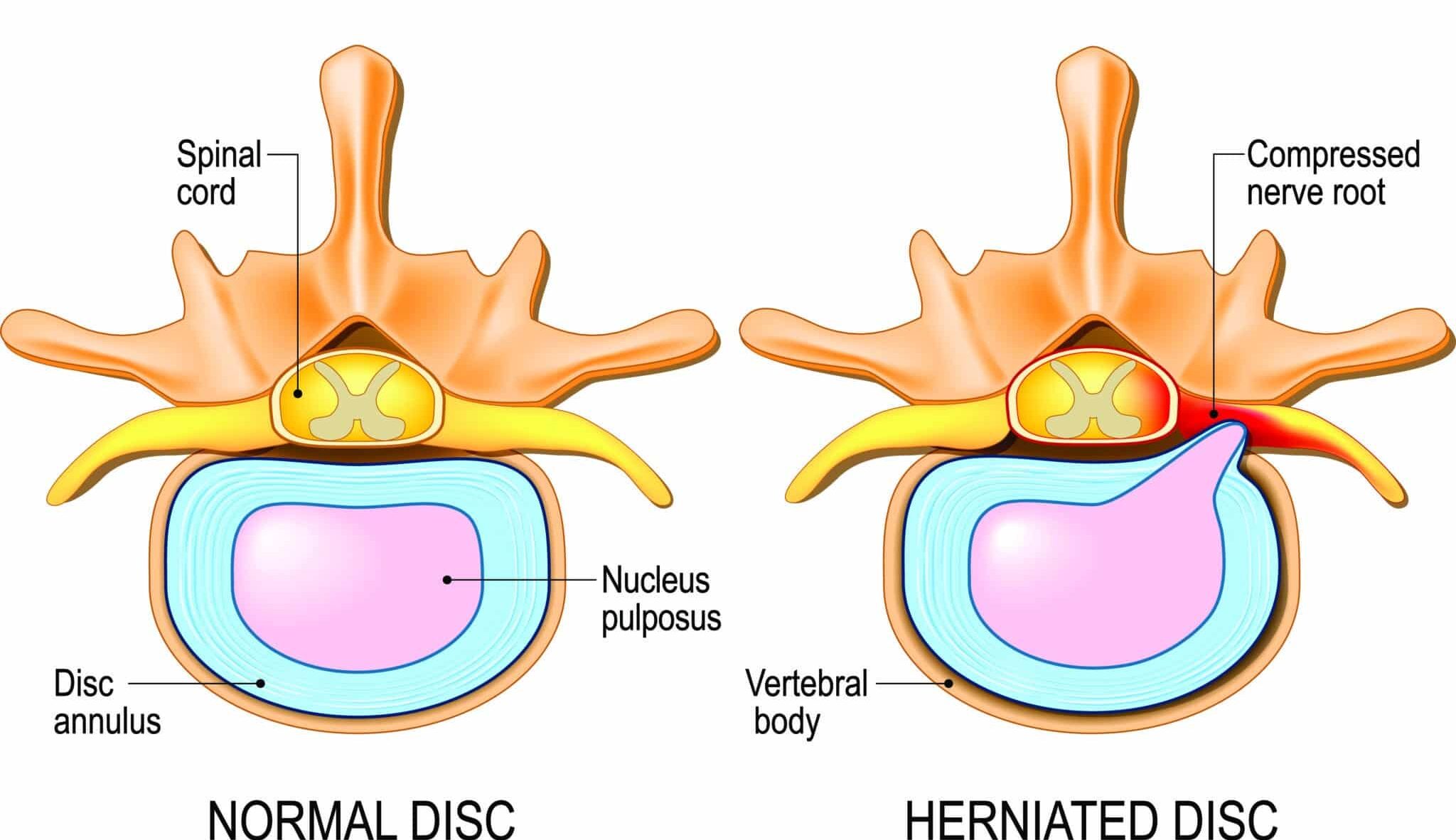 nucleus pulposus