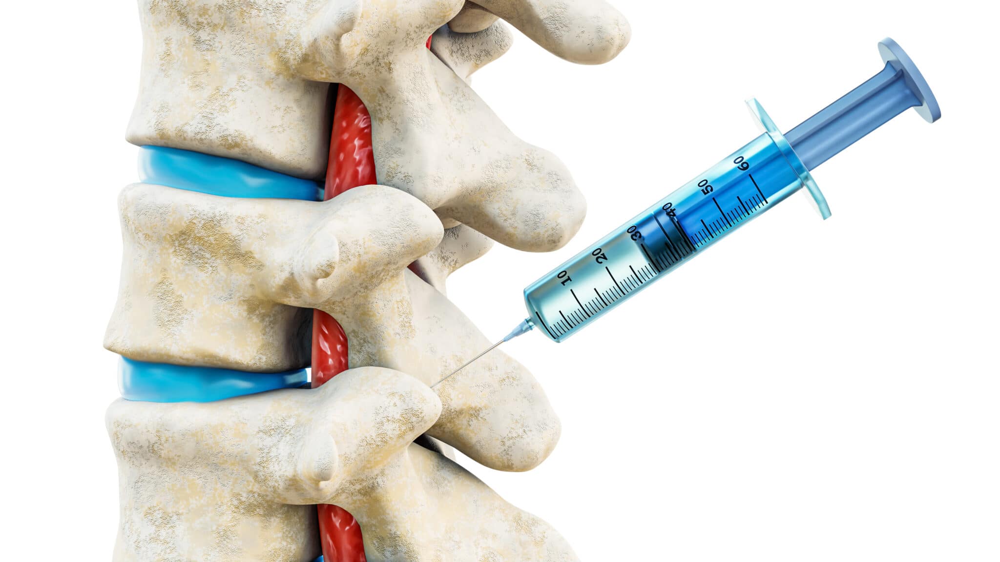 Facet Joint Injections Everything You Need To Know Spine Info