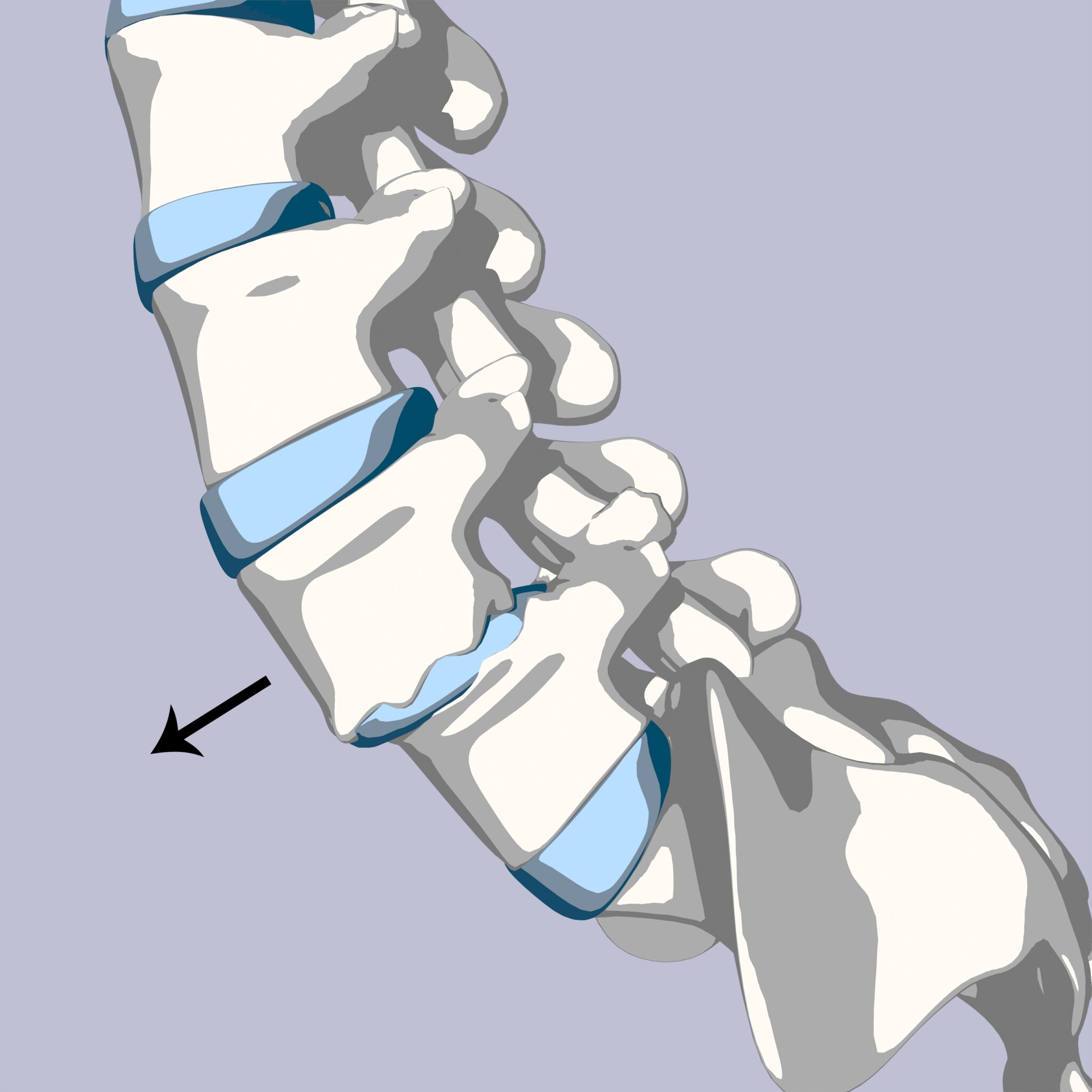 Anterolisthesis, spondylolisthesis