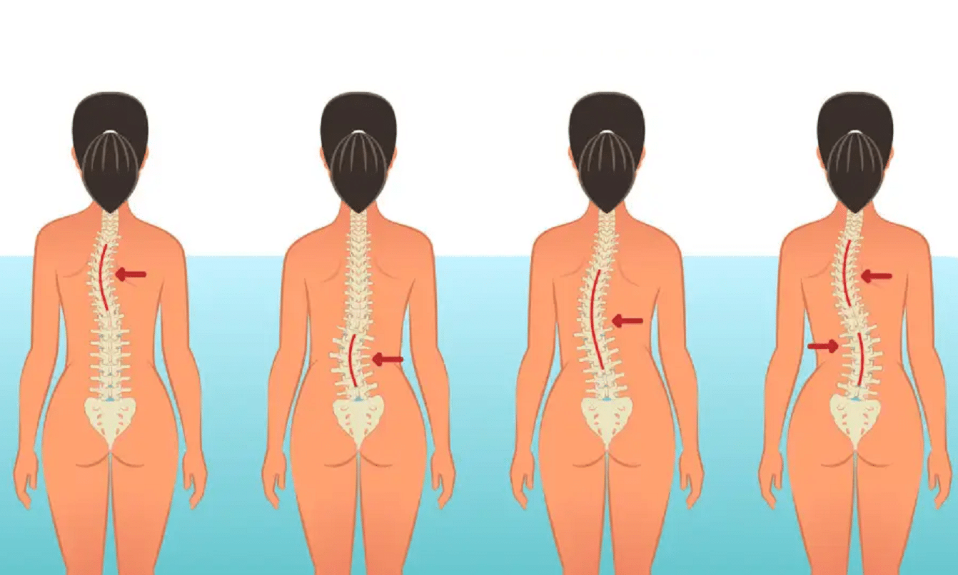 Juvenile Idiopathic Scoliosis