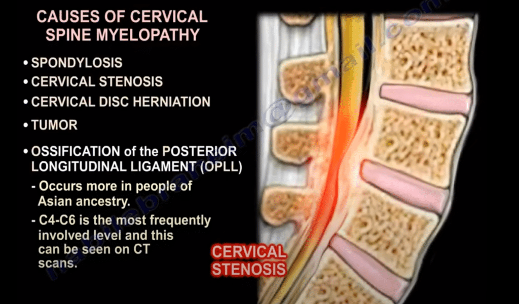 Myelopathy: Definition - Spine Info