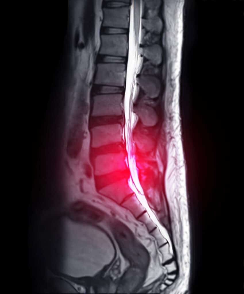 modic-changes-of-the-spine-meaning-and-significance-spine-info