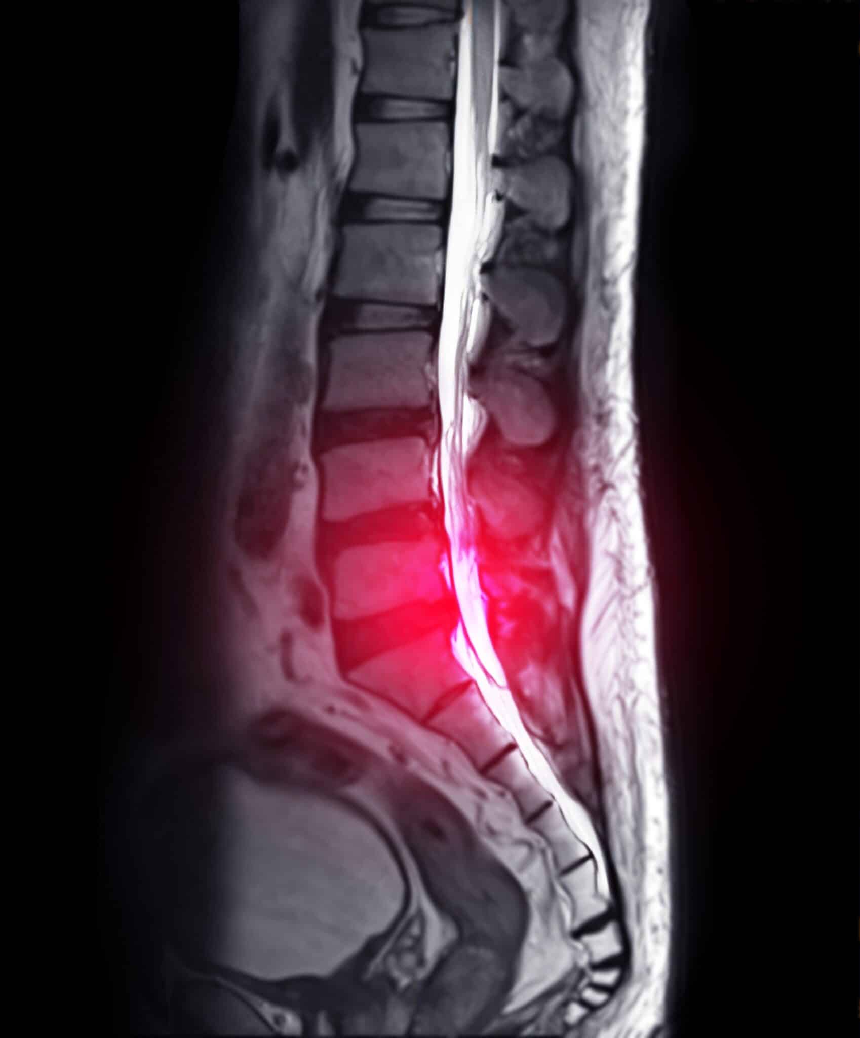 Modic Changes Of The Spine Meaning And Significance Spine Info