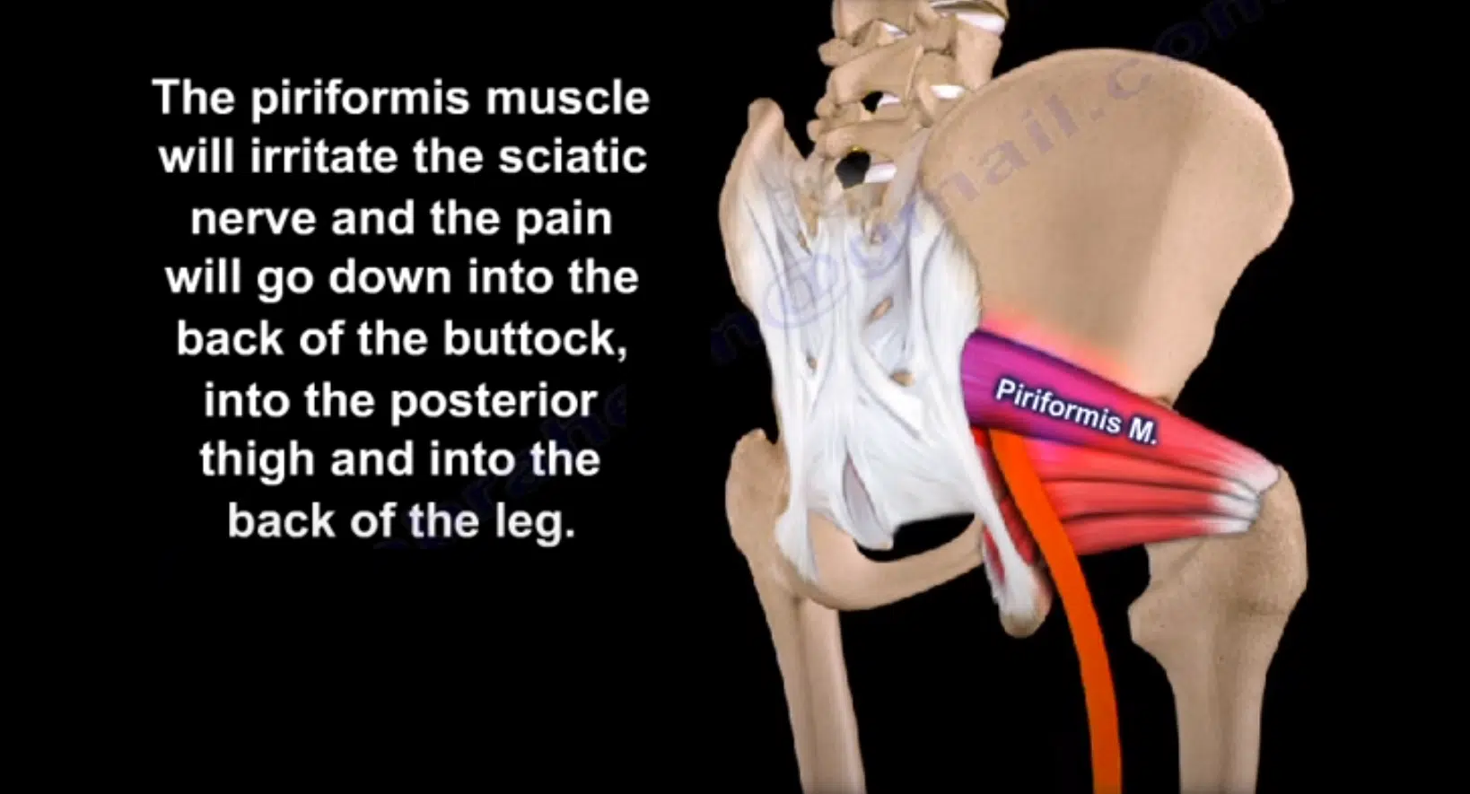 Piriformis syndrome can cause buttock pain and sciatica