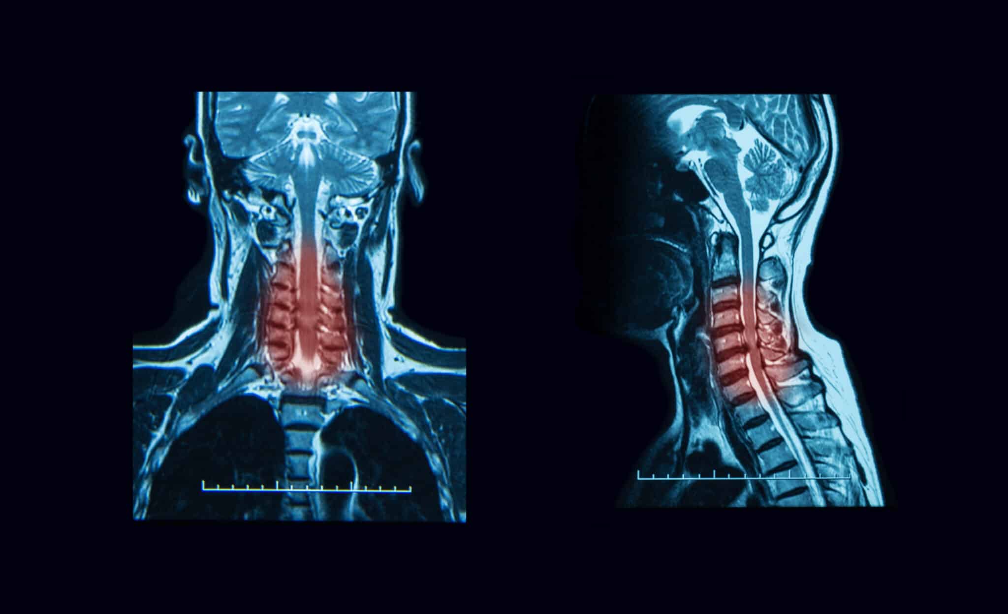 Myelopathy