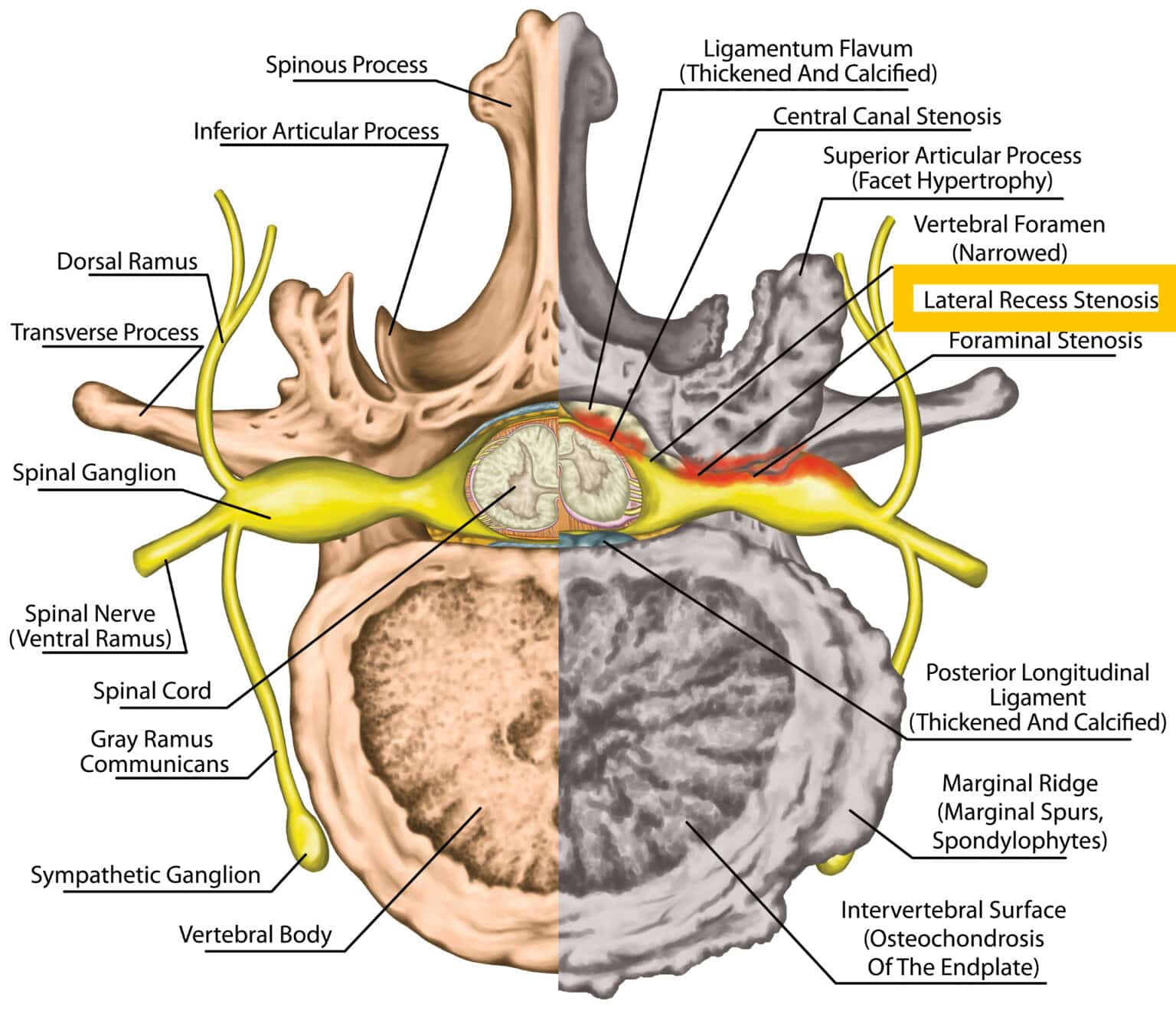 Lateral Recess Stenosis: Anatomy, Causes, Symptoms, Diagnosis, and ...