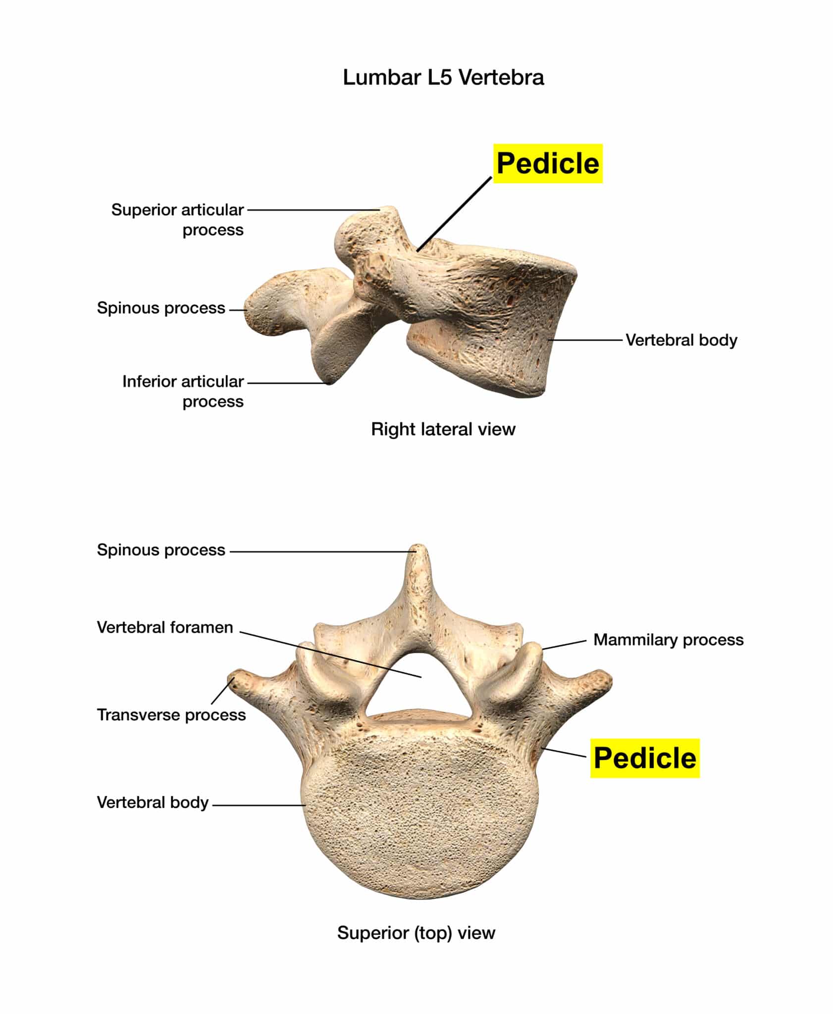 Pedicle Screws for Spinal Fusion - Spine Info