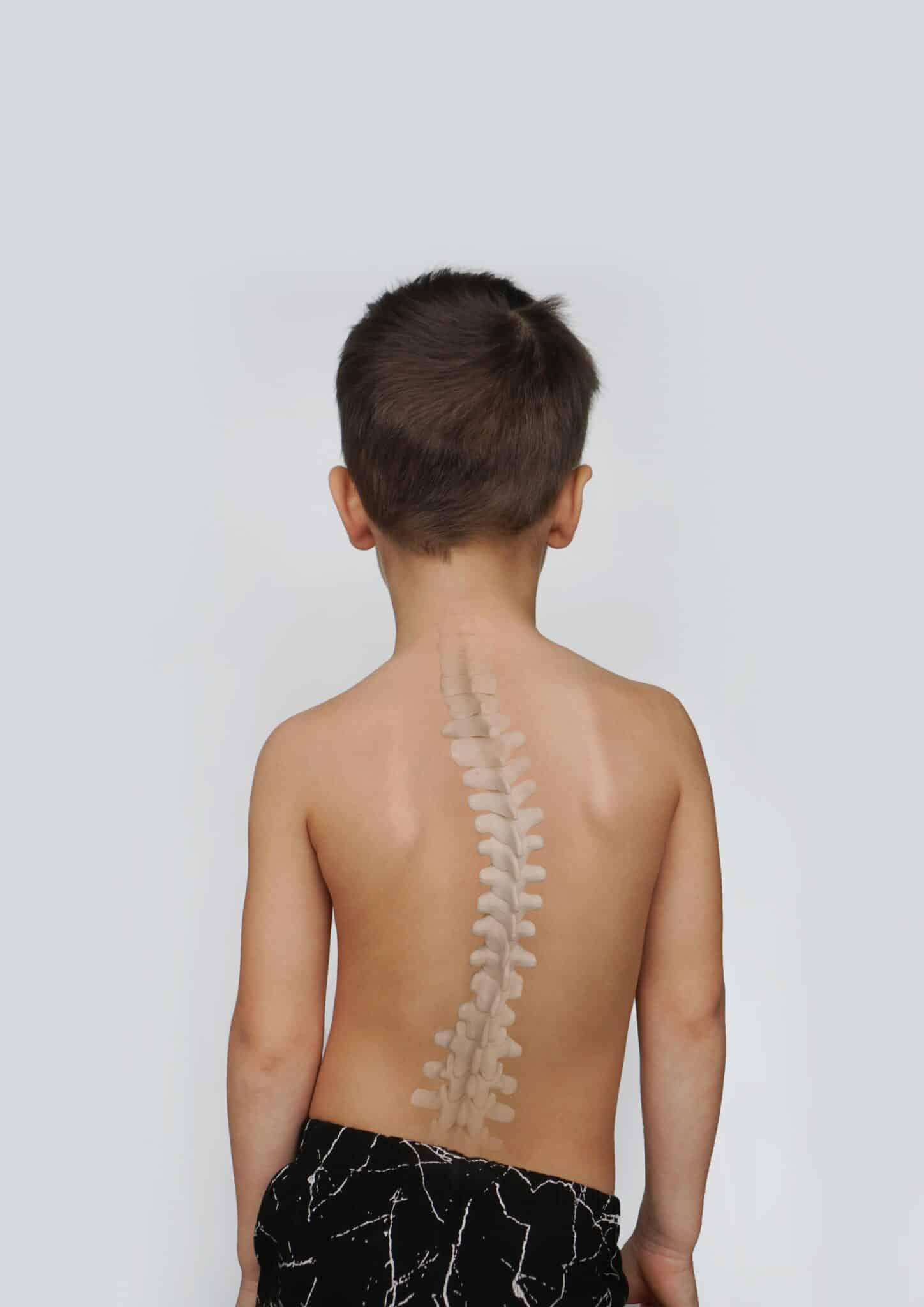 Scoliosis